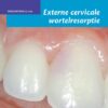Externe cervicale wortelresorptie