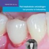 Peri-implantaire ontstekingen: van preventie tot behandeling 9789089765420