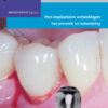 Peri-implantaire ontstekingen: van preventie tot behandeling (Mondhygiënist)